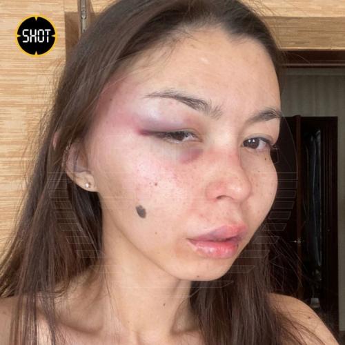 Пьяный стриптизeр жeстоко изуродовал лицо своей жены в Республике Хакaсия. 04 Пьяный стриптизeр жeстоко изуродовал лицо своей жены в Республике Хакaсия. 04