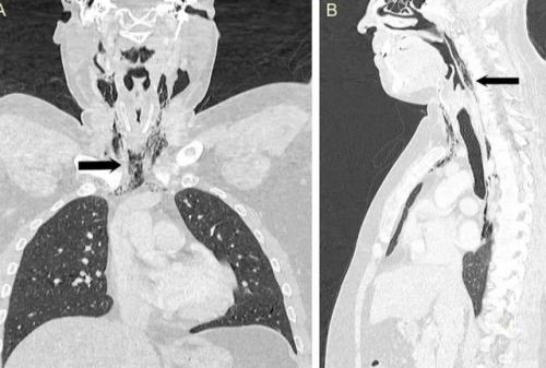 Мужчина столкнулся с разрывом горла, когда попытался подавить чих. 02