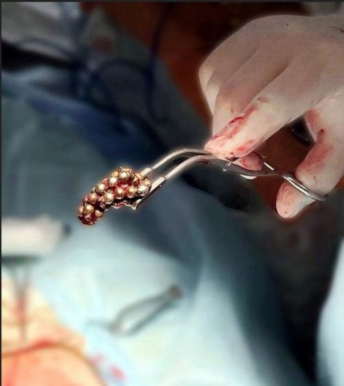 Школьники решили проверить, что будет, если всунуть в себя это. 01